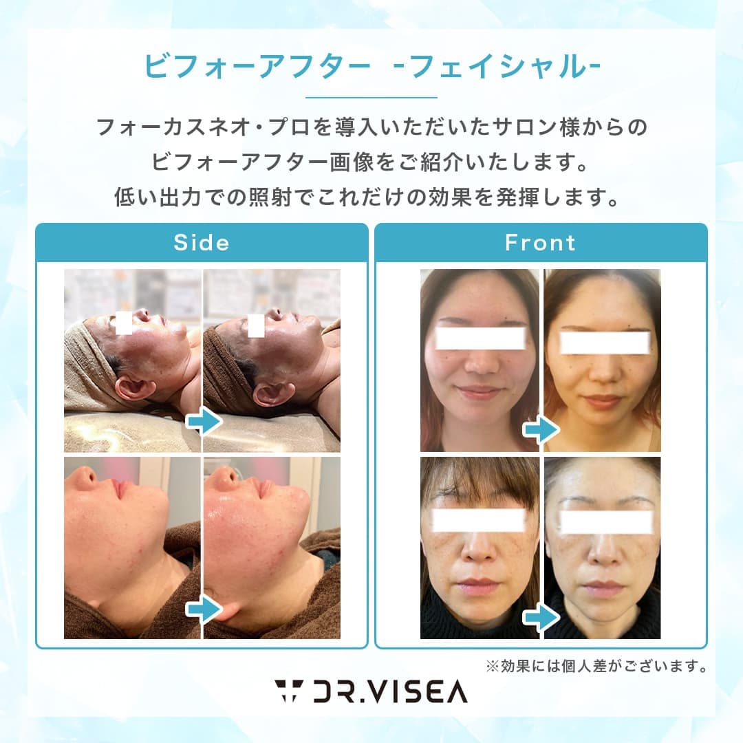 フェイシャルハイフ